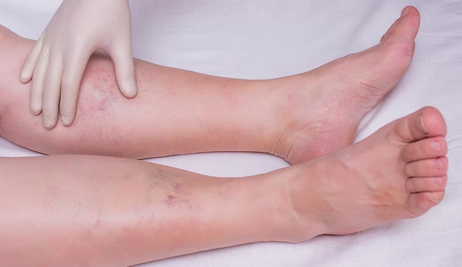 Cuidados para aliviar inchaço e varizes nas pernas