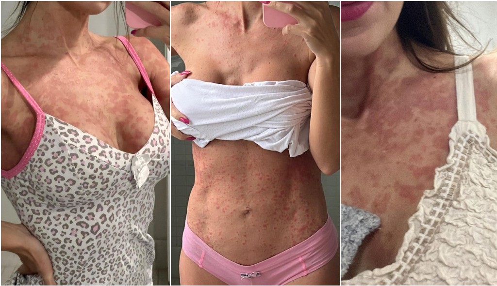 Dermatite Psoriasiforme: a doença que deixou o corpo da ex-BBB Letícia Santiago manchado