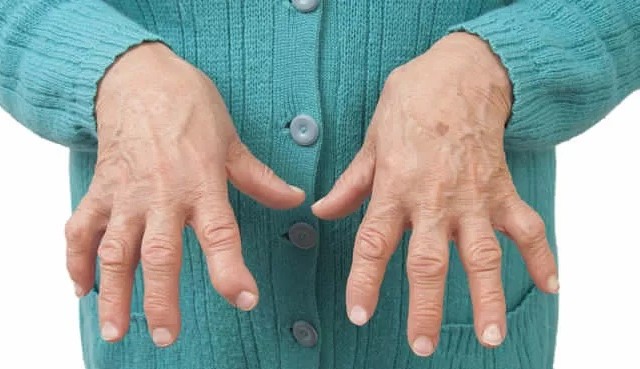 Conheça os sintomas, tratamento e mitos da artrite reumatoide