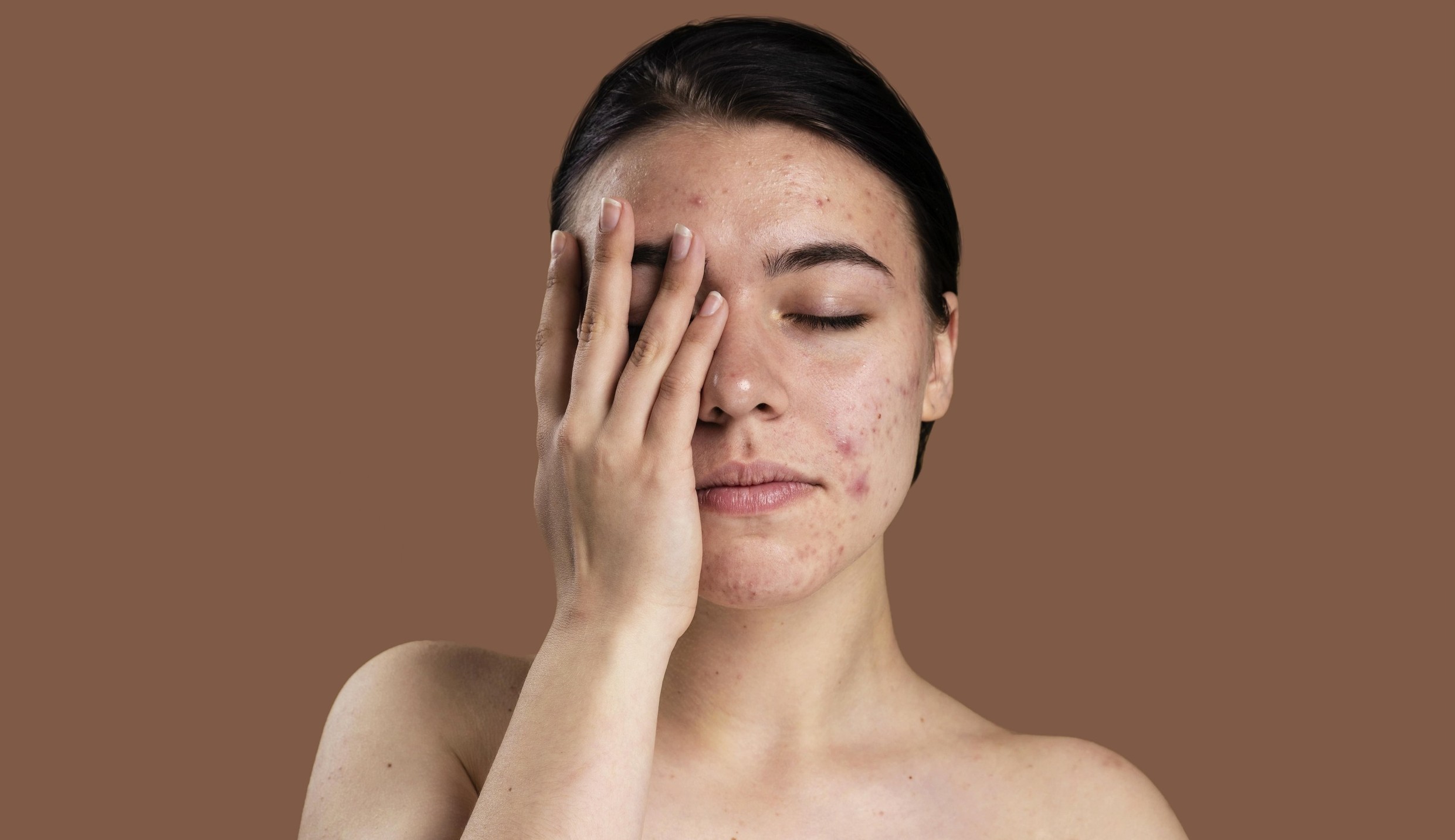 Melasma: o que deixa nossa pele manchada e como tratar?