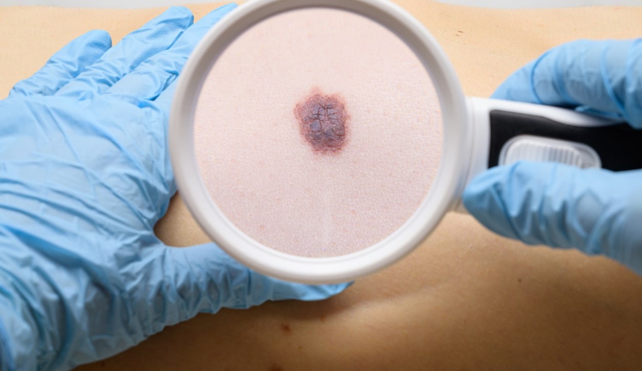 Técnica usada em vacina para Covid pode tratar câncer de pele
