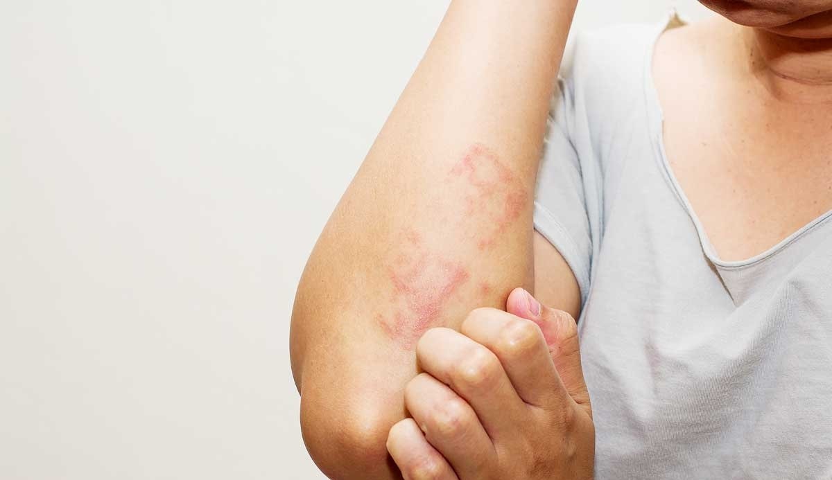 Alergias de pele no Inverno: saiba como surgem e veja como evitar