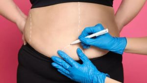 Procedimentos pós bariátrica: curiosidades e recomendações