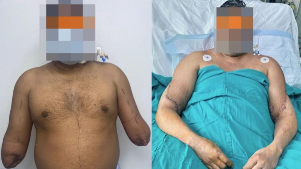 Homem recupera os dois braços após transplante raro; entenda o caso