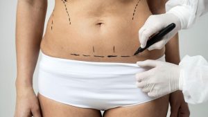 Dr. Cláudio Dias Rodrigues explica como funciona a cirurgia de lipoaspiração
