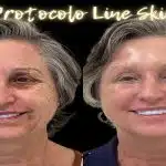 Peeling de fenol provoca morte