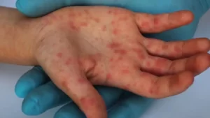 Casos de sarampo nos EUA têm aumento significativo  e ultrapassam o total de todo o ano passado