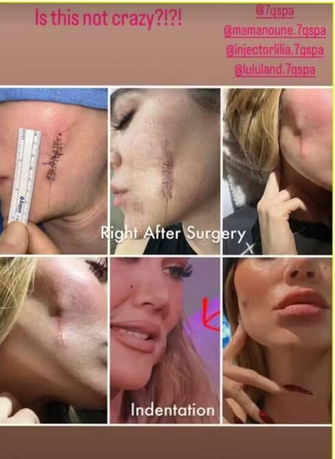 Khloé Kardashian comenta sobre cicatriz depois de retirada de tumor facial