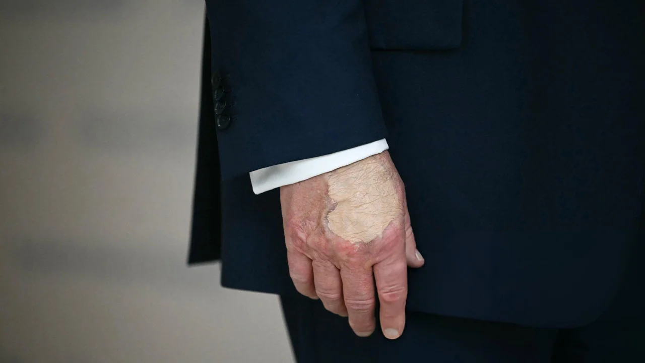 Trump reaparece em público com maquiagem na mão direita após hematomas