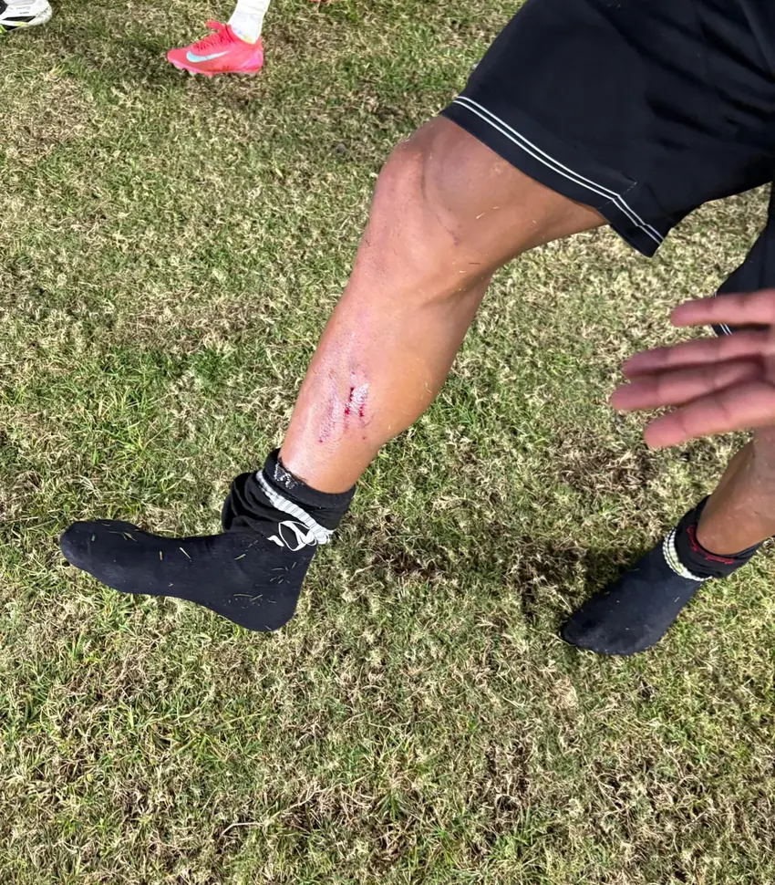 Canela de Paulo Henrique após dividida com Lyanco 