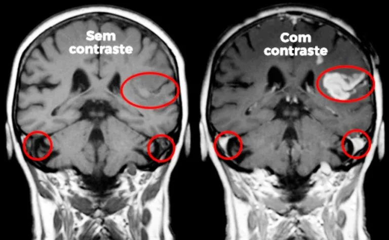 Imagem comparando uma tomografia com e sem contraste.