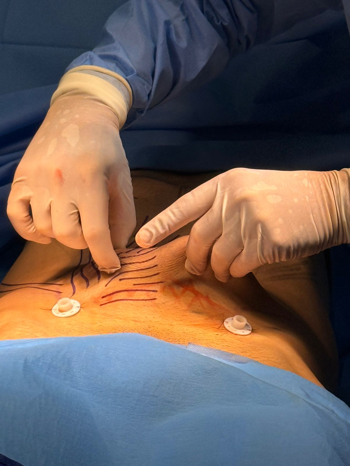 Dr. Cássio Vilhena explica como o Ignite RF eleva o padrão de acabamento em cirurgias plásticas Dr. Cássio Vilhena explica como o Ignite RF eleva o padrão de acabamento em cirurgias plásticas