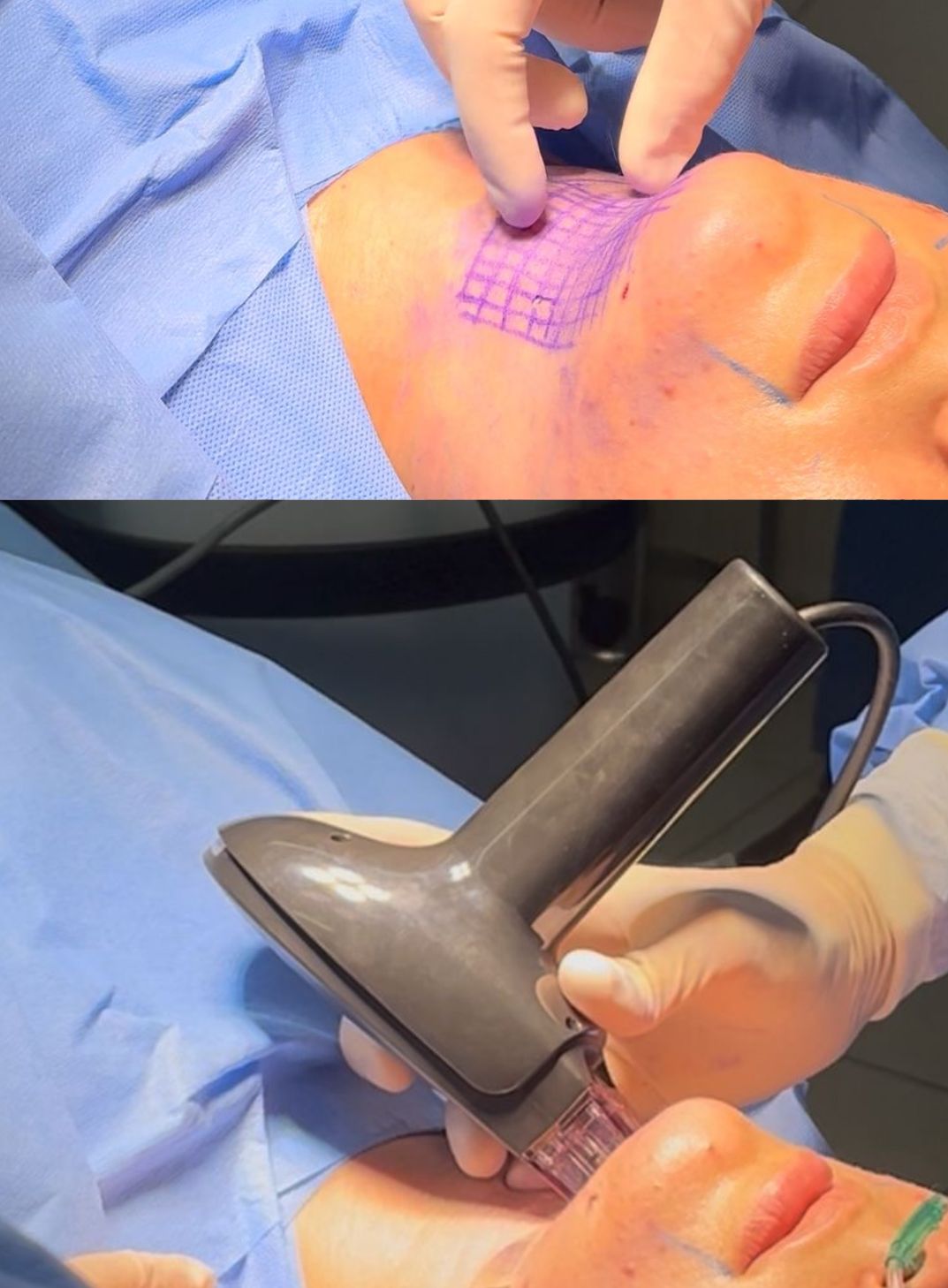 Dr. Cássio Vilhena explica como o Ignite RF eleva o padrão de acabamento em cirurgias plásticas Dr. Cássio Vilhena explica como o Ignite RF eleva o padrão de acabamento em cirurgias plásticas