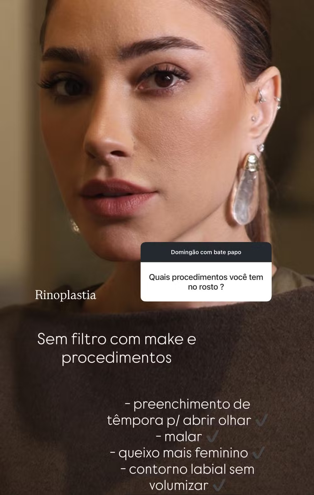 Romana Novais detalha procedimentos no rosto A médica e influenciadora Romana Novais detalha em suas redes sociais sobre os 5 procedimentos estéticos que já realizou