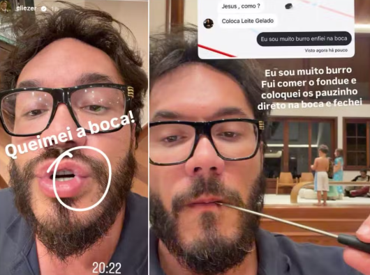 Eliezer se machuca em acidente doméstico e sofre queimadura Eliezer se machuca em acidente doméstico e sofre queimadura
