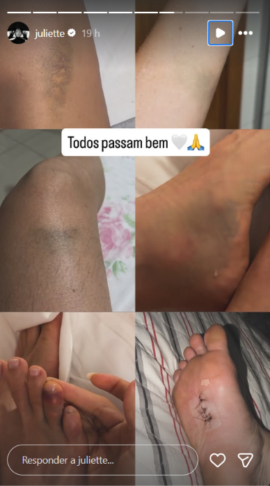 Juliette revela marcas da despedida de solteira e surpreende ao brincar: “Confundiram com o fim do mundo”