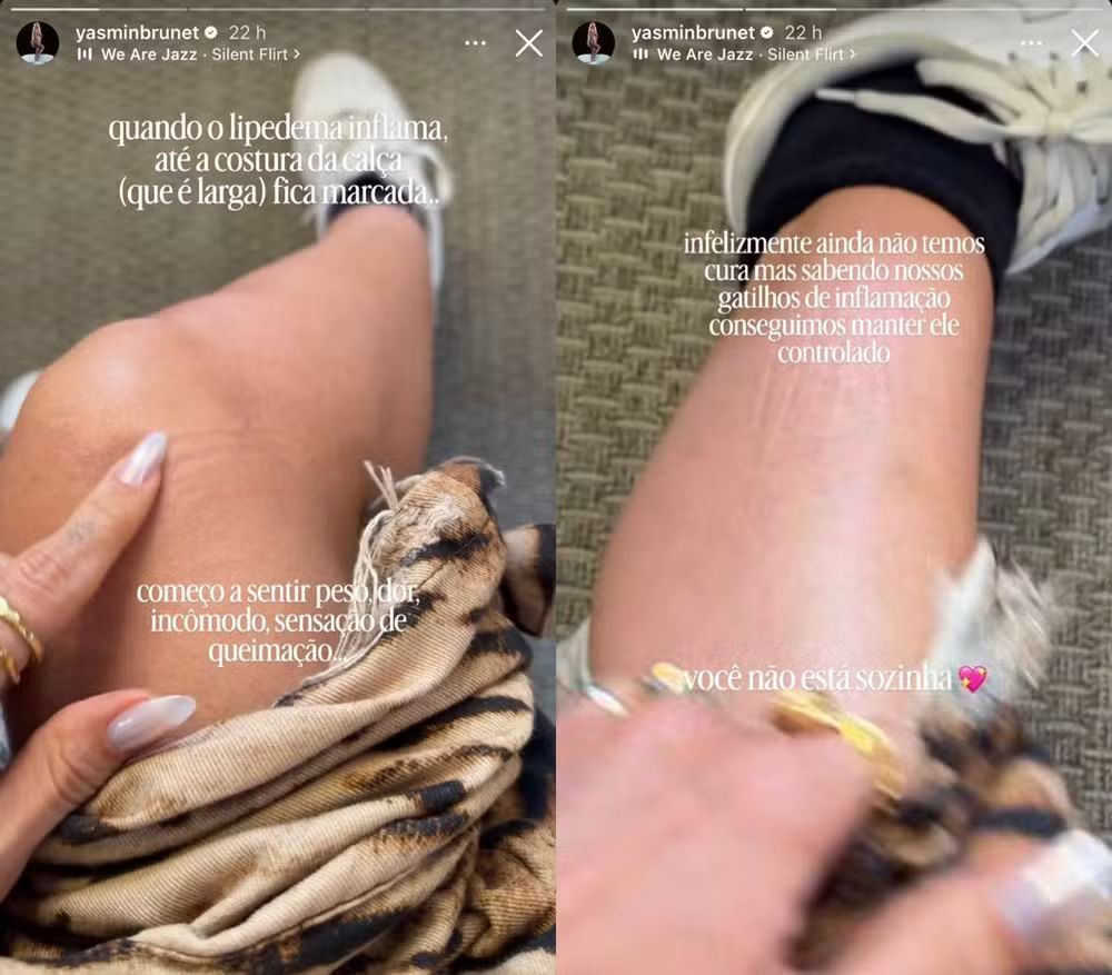 Yasmin Brunet fala sobre lipedema e revela sentir dor e queimação Yasmin Brunet fala sobre lipedema e revela sentir dor e queimação
