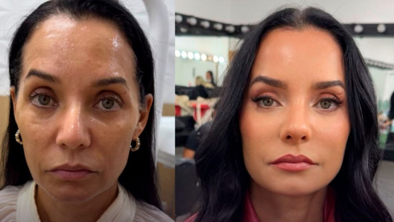 Mônica Carvalho surpreende com resultado de harmonização facial